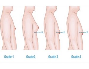 Best Male Breast Reduction Surgeon