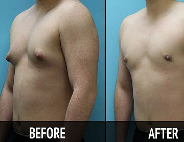 Male Breast Reduction Surgery in Kolkata