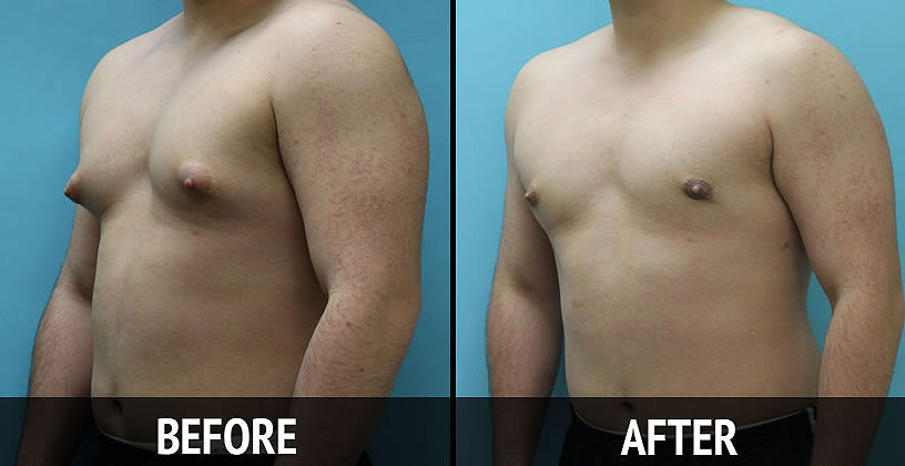 Best Gynecomastia Surgeon in Kolkata