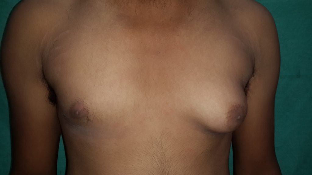 Best Gynecomastia