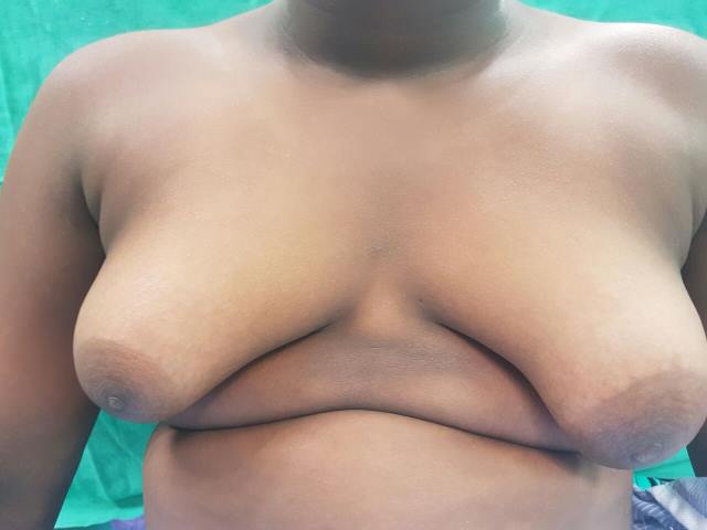 Male Breast 
